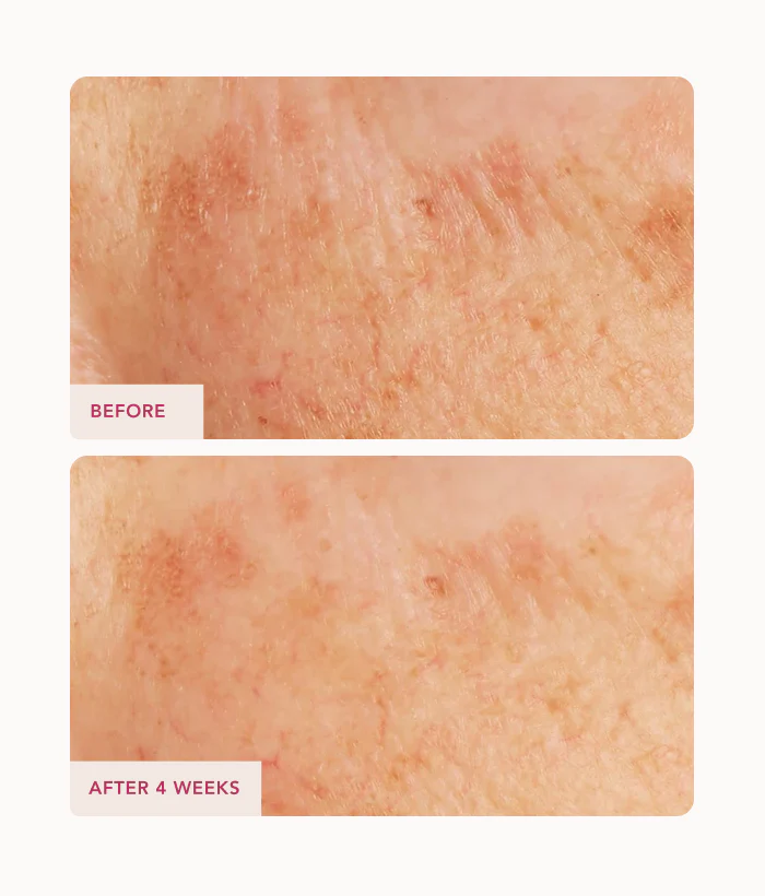 Caviar Lime Acid Peel - Image 4