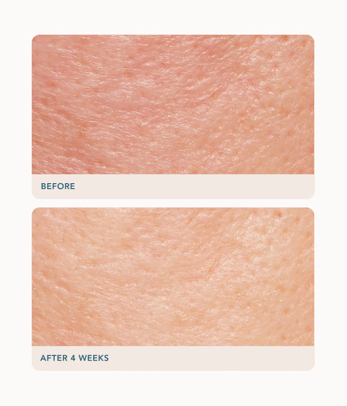 Retexturizing Treatment - Image 4